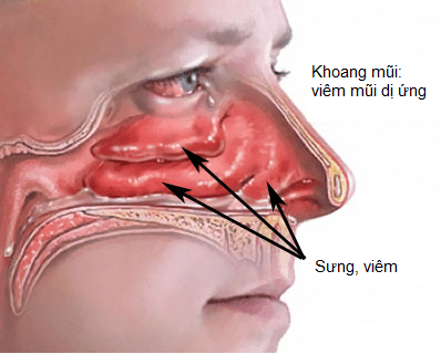 Bệnh viêm mũi dị ứng là gì?